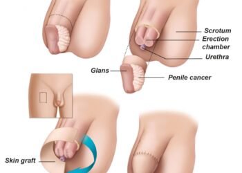 When Silence Hurts: Understanding Penectomy Through the Stories We Rarely Tell