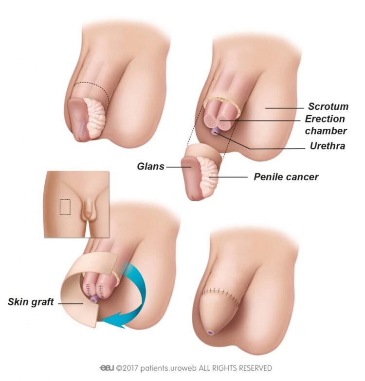 When Silence Hurts: Understanding Penectomy Through the Stories We Rarely Tell